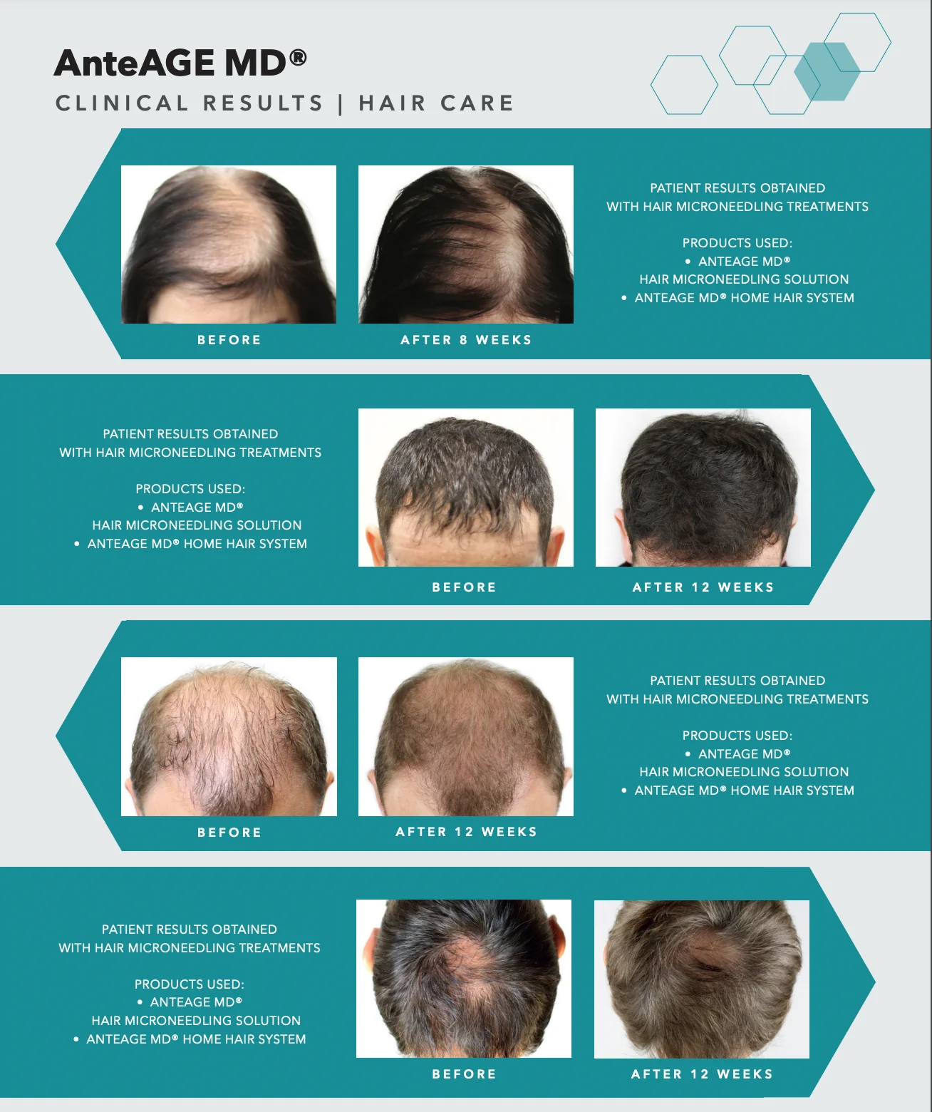 AnteAge MD Home Hair System