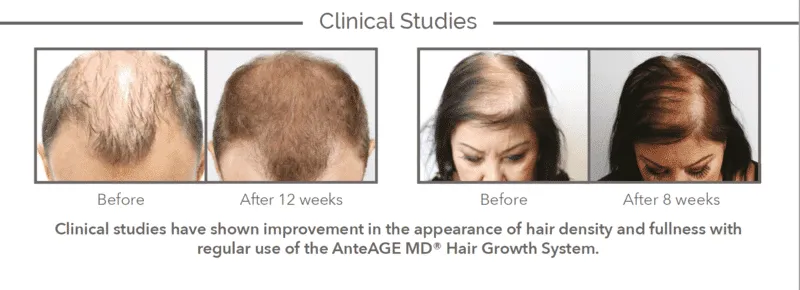 AnteAge MD Home Hair System