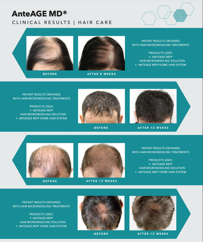 AnteAge MD Home Hair System